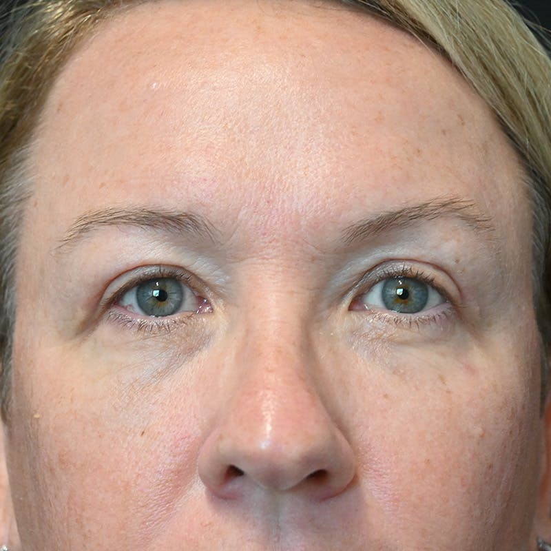 Upper Eyelid Surgery Before & After Gallery - Patient 135340 - Image 2