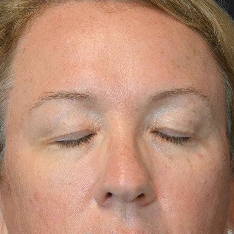 Upper Eyelid Surgery Before & After Gallery - Patient 135340 - Image 3