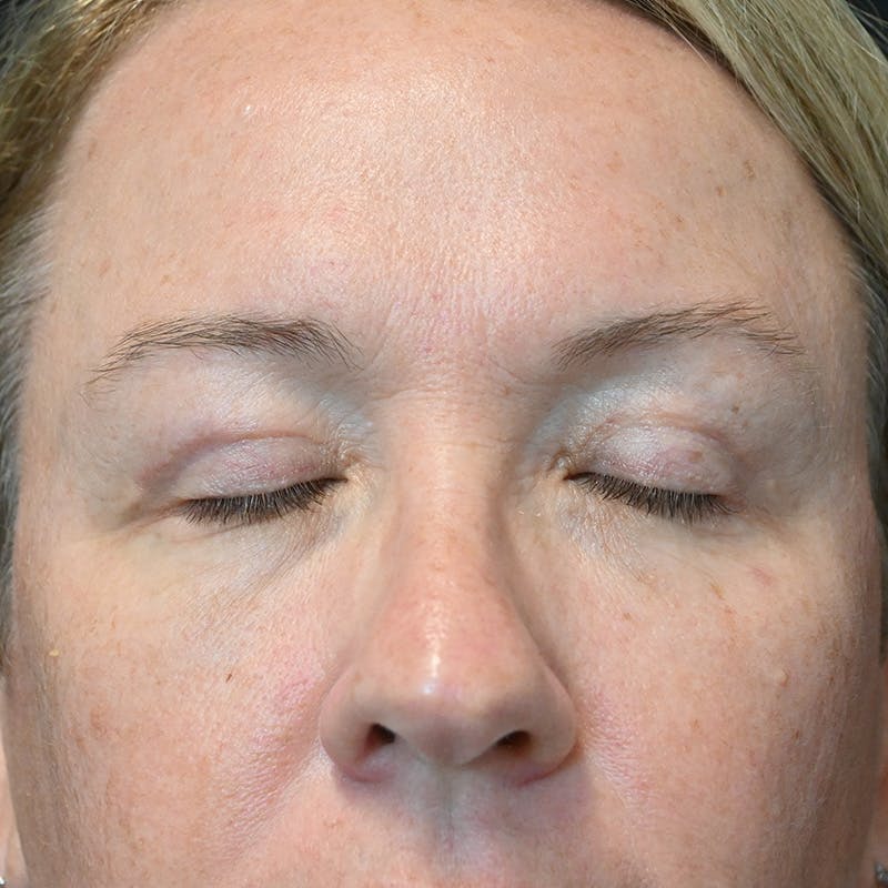 Upper Eyelid Surgery Before & After Gallery - Patient 135340 - Image 4