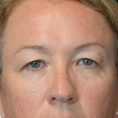 Upper Eyelid Surgery Before & After Gallery - Patient 135340 - Image 1