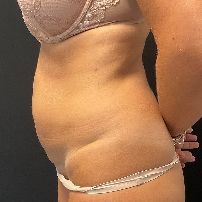 Abdominoplasty (Tummy Tuck) Before & After Gallery - Patient 363124 - Image 9