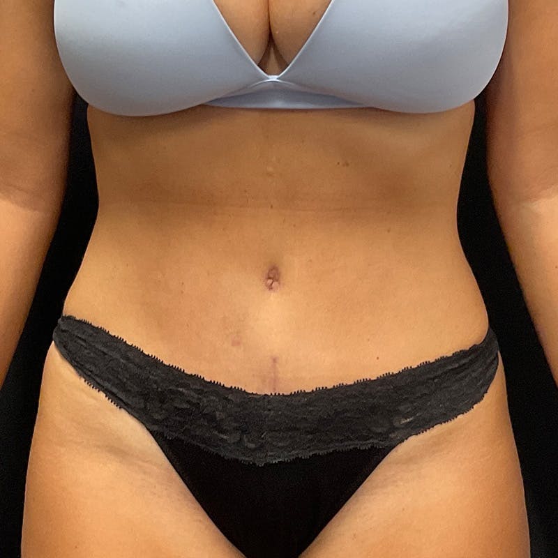 Abdominoplasty (Tummy Tuck) Before & After Gallery - Patient 363124 - Image 2