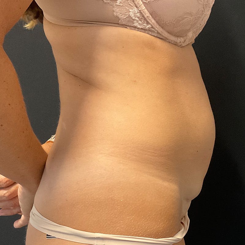 Abdominoplasty (Tummy Tuck) Before & After Gallery - Patient 363124 - Image 5