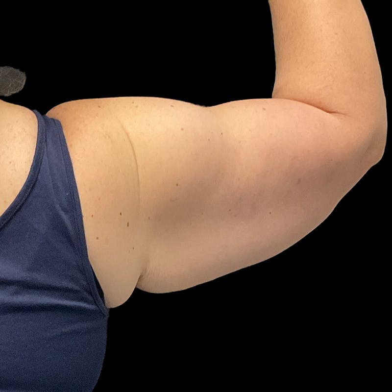 Arm Lift Before & After Gallery - Patient 256415 - Image 3