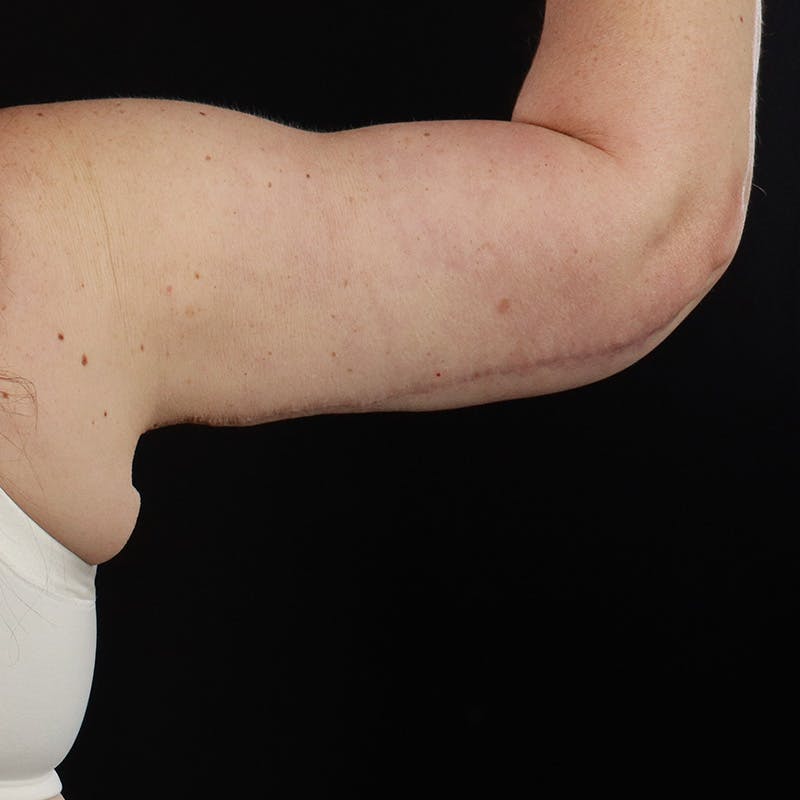 Arm Lift Before & After Gallery - Patient 256415 - Image 4