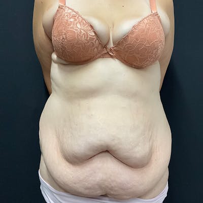 Body Lift Before & After Gallery - Patient 342299 - Image 1
