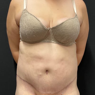 Body Lift Before & After Gallery - Patient 342299 - Image 2
