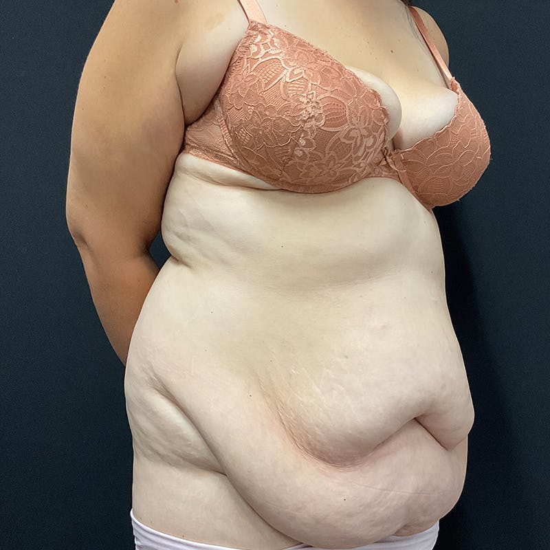 Body Lift Before & After Gallery - Patient 342299 - Image 3