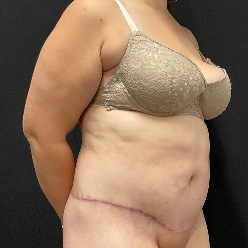 Body Lift Before & After Gallery - Patient 342299 - Image 4