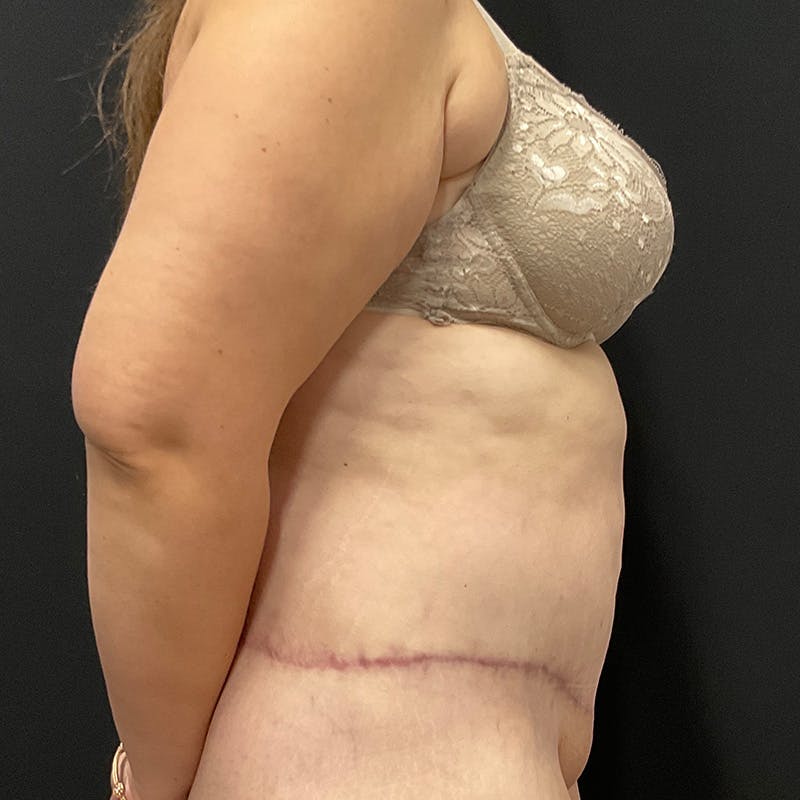 Body Lift Before & After Gallery - Patient 342299 - Image 6