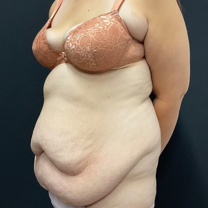 Body Lift Before & After Gallery - Patient 342299 - Image 7