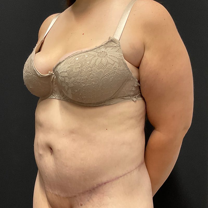 Body Lift Before & After Gallery - Patient 342299 - Image 8