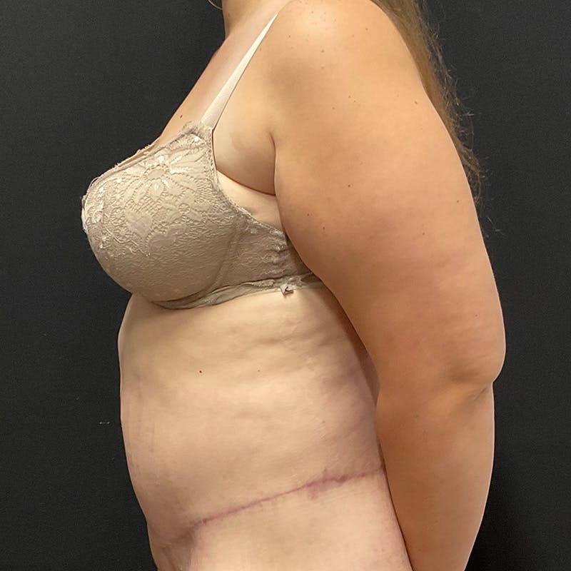 Body Lift Before & After Gallery - Patient 342299 - Image 10