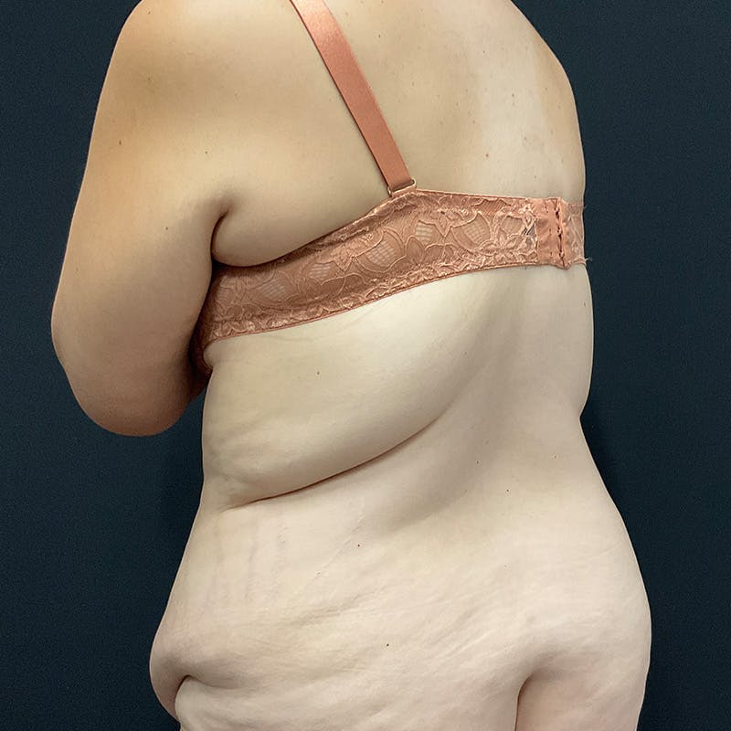 Body Lift Before & After Gallery - Patient 342299 - Image 11