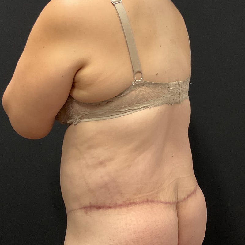 Body Lift Before & After Gallery - Patient 342299 - Image 12