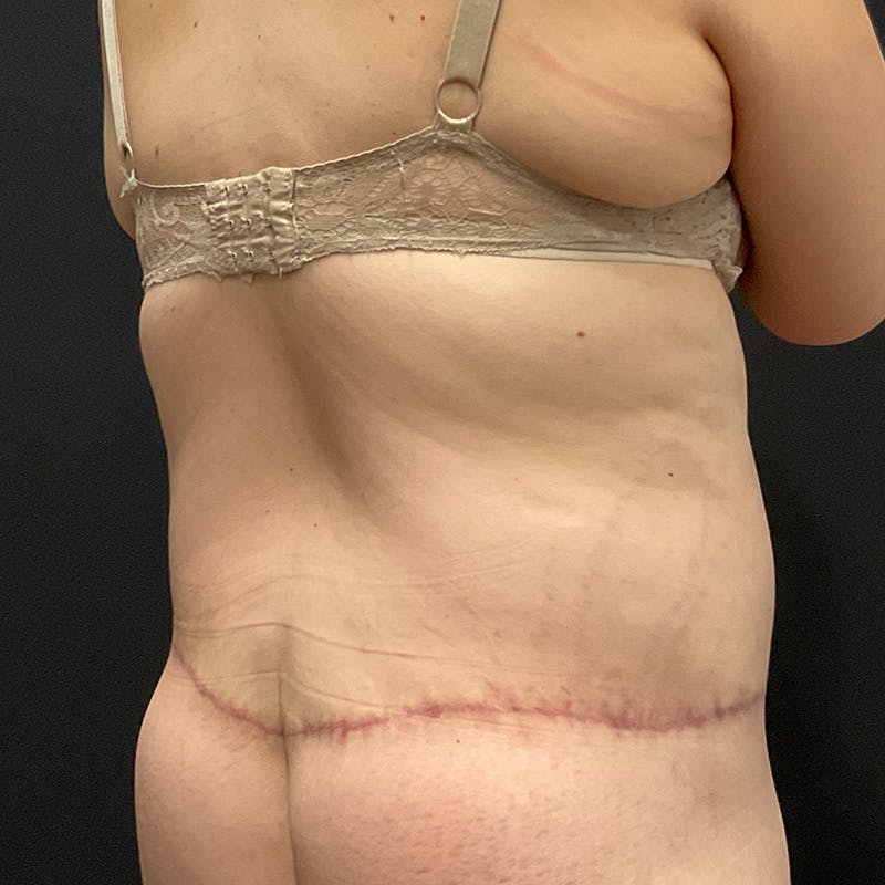 Body Lift Before & After Gallery - Patient 342299 - Image 14