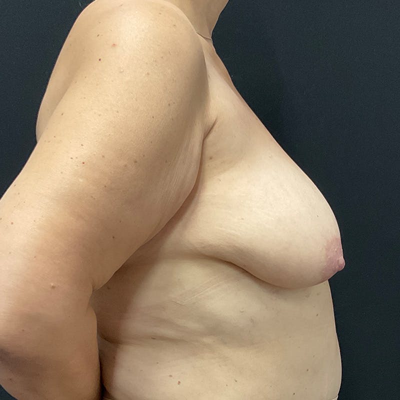 Breast Lift Before & After Gallery - Patient 191838 - Image 5