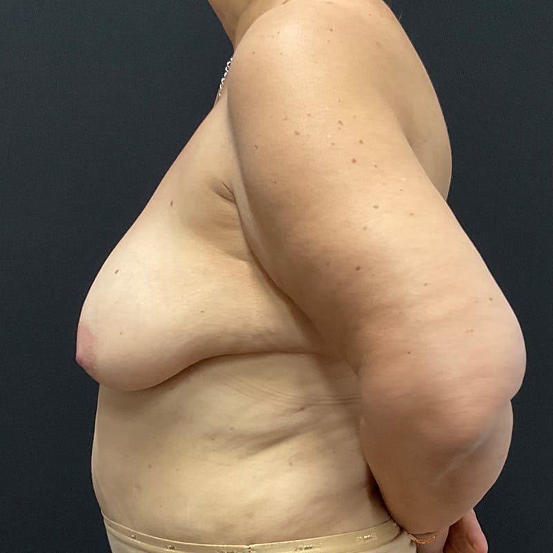 Breast Lift Before & After Gallery - Patient 191838 - Image 9