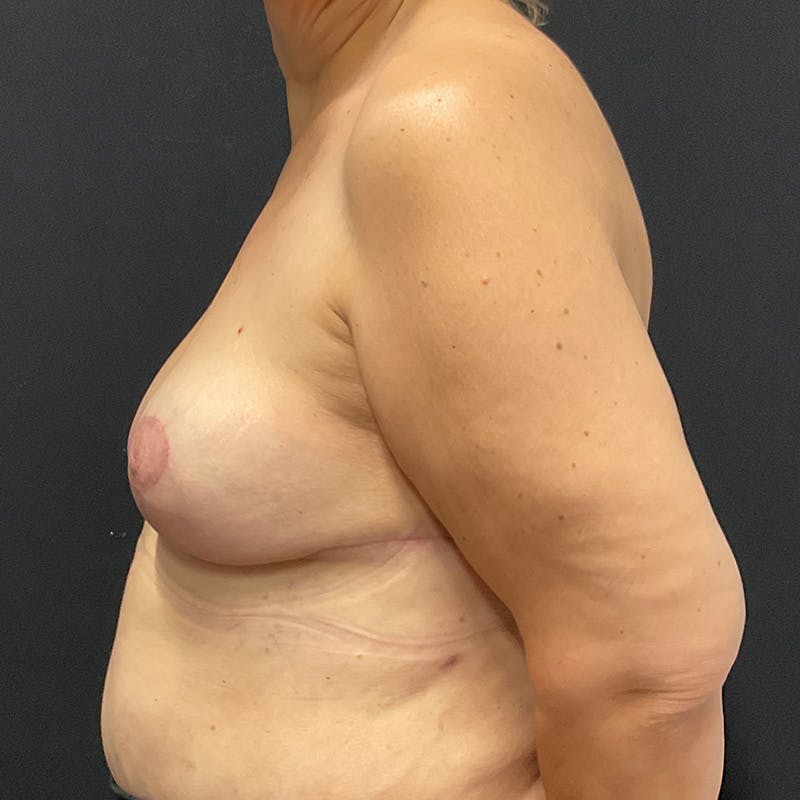 Breast Lift Before & After Gallery - Patient 191838 - Image 10