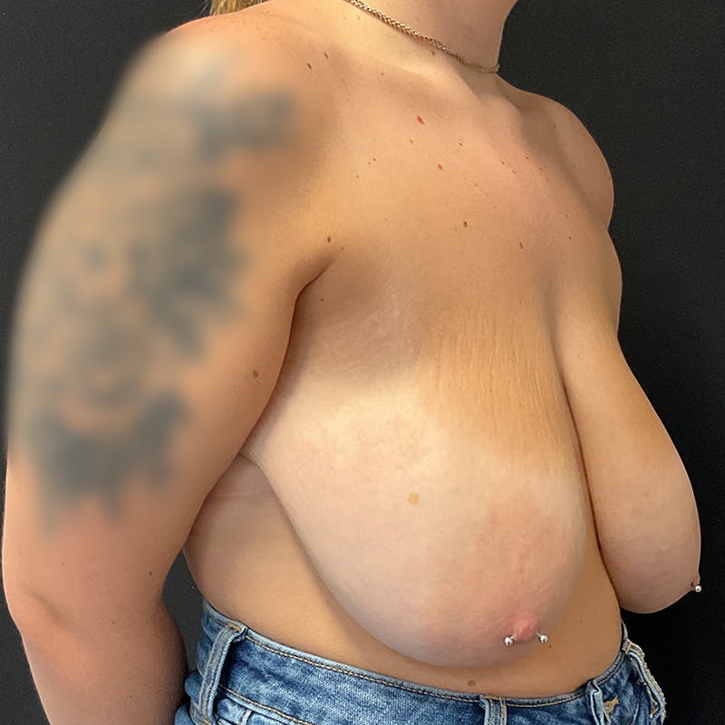 Breast Reduction Before & After Gallery - Patient 370874 - Image 3