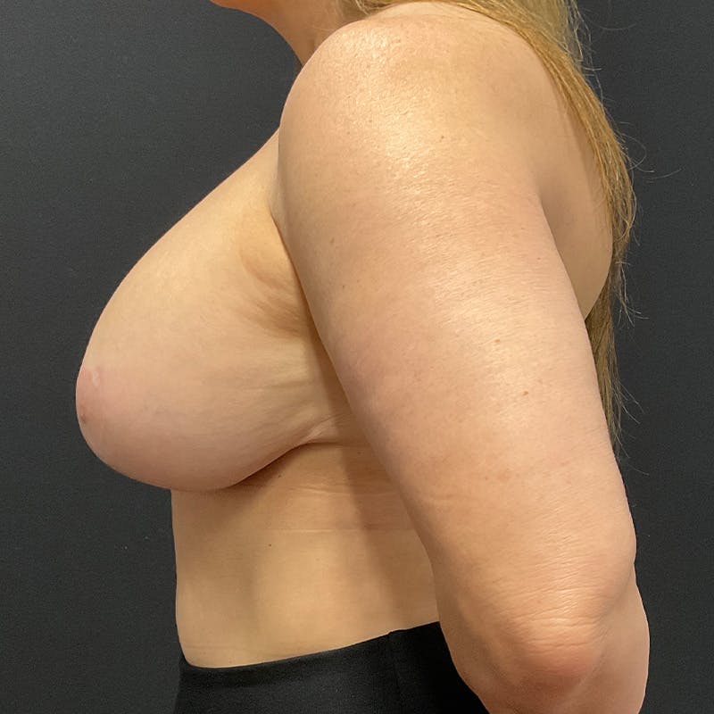 Breast Revision Before & After Gallery - Patient 434807 - Image 10