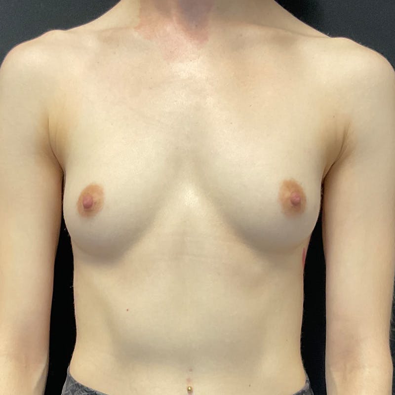 Breast Augmentation Before & After Gallery - Patient 197942 - Image 1
