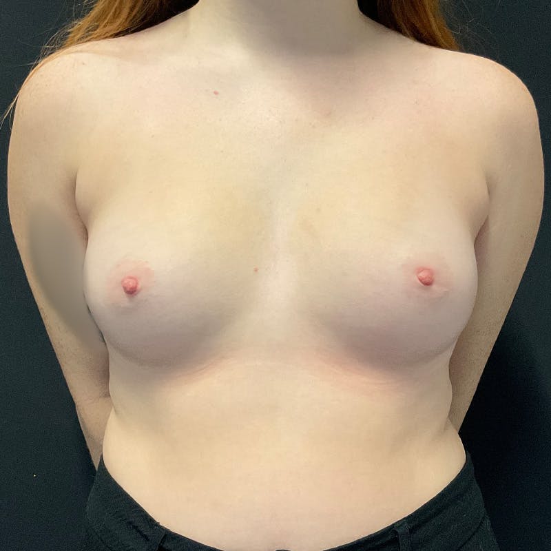 Breast Augmentation Before & After Gallery - Patient 340551 - Image 1