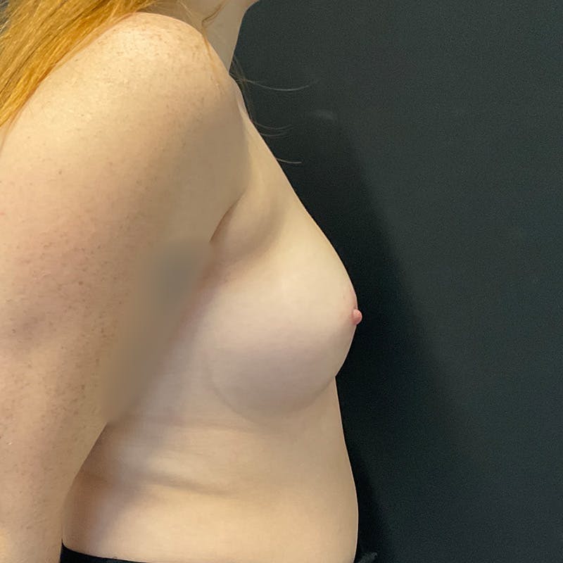 Breast Augmentation Before & After Gallery - Patient 340551 - Image 5