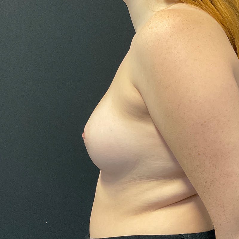 Breast Augmentation Before & After Gallery - Patient 340551 - Image 9