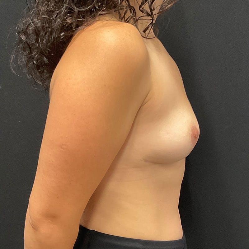 Breast Explant with Lift Before & After Gallery - Patient 412410 - Image 6
