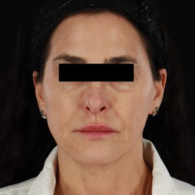 Dermal Fillers Before & After Gallery - Patient 218120 - Image 1