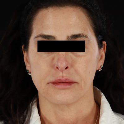 Dermal Fillers Before & After Gallery - Patient 218120 - Image 2