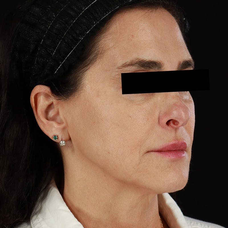 Dermal Fillers Before & After Gallery - Patient 218120 - Image 3