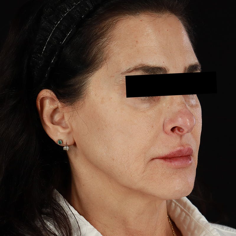 Dermal Fillers Before & After Gallery - Patient 218120 - Image 4