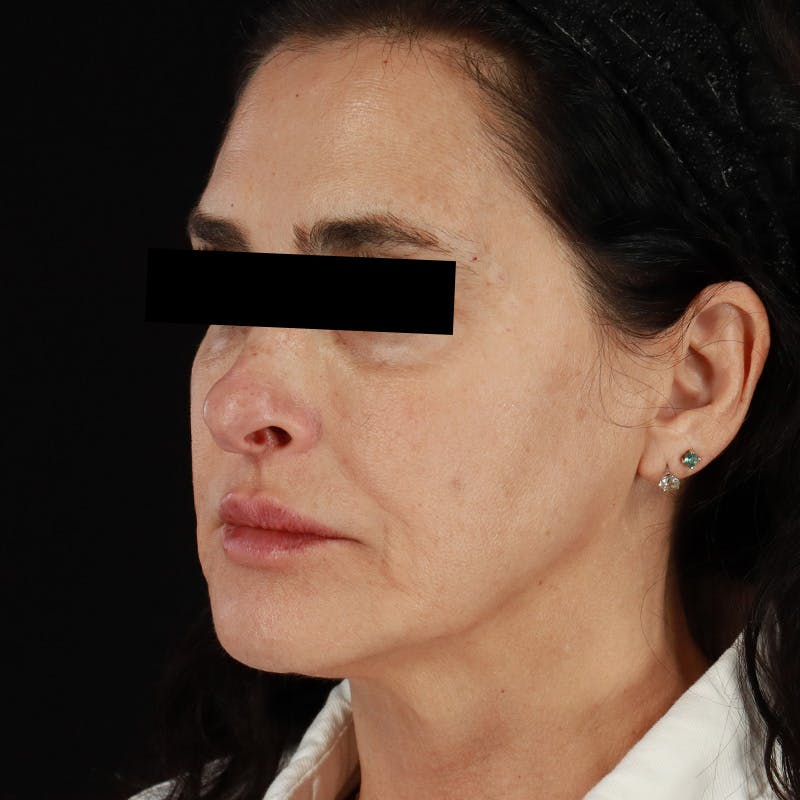 Dermal Fillers Before & After Gallery - Patient 218120 - Image 6