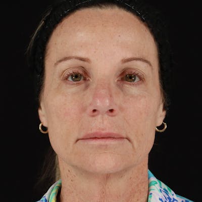Dermal Fillers Before & After Gallery - Patient 220967 - Image 1