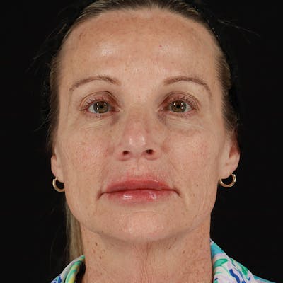 Dermal Fillers Before & After Gallery - Patient 220967 - Image 2