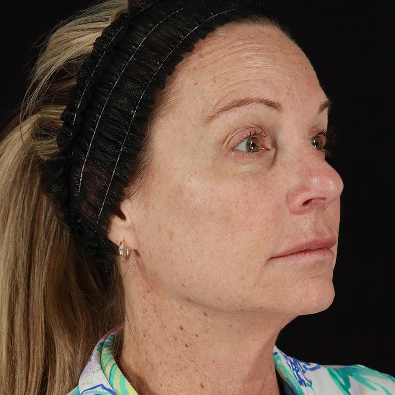 Dermal Fillers Before & After Gallery - Patient 220967 - Image 3