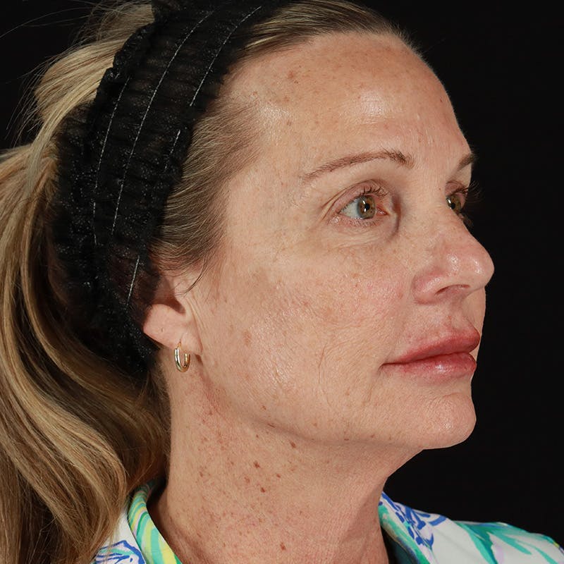 Dermal Fillers Before & After Gallery - Patient 220967 - Image 4