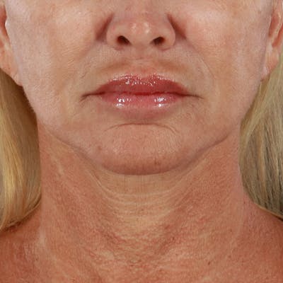 Microneedling Before & After Gallery - Patient 135177 - Image 1