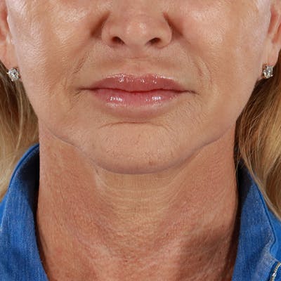 Microneedling Before & After Gallery - Patient 135177 - Image 2