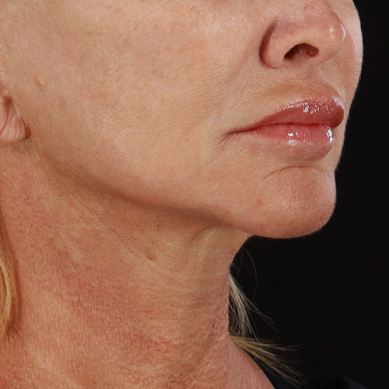 Microneedling Before & After Gallery - Patient 135177 - Image 3