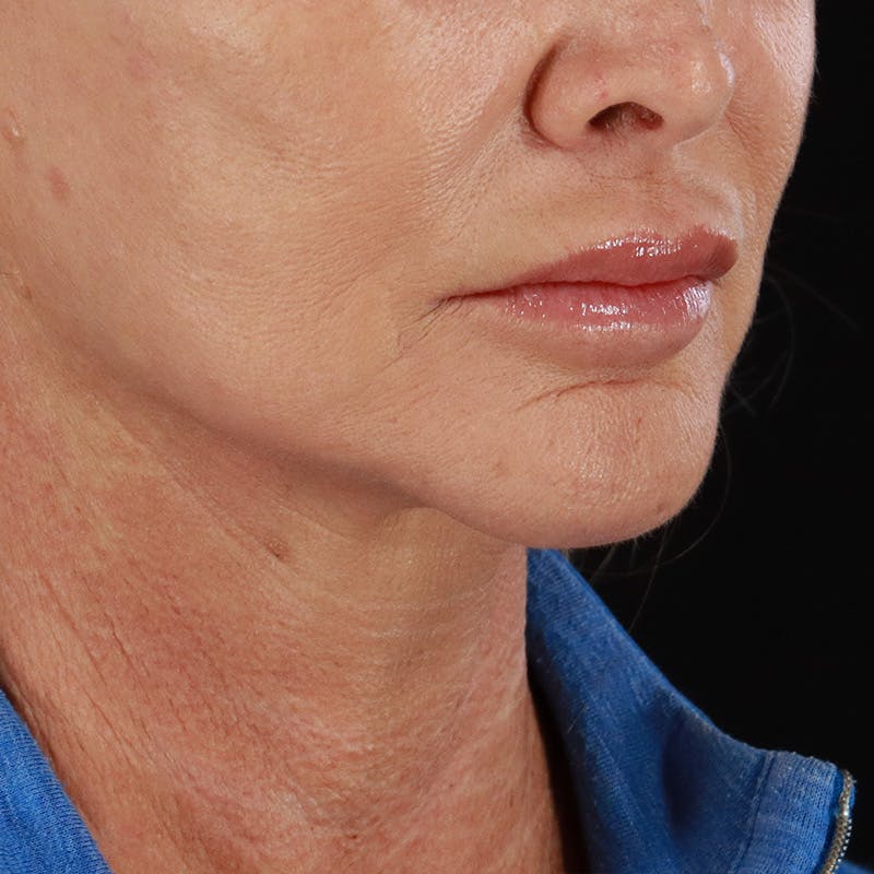 Microneedling Before & After Gallery - Patient 135177 - Image 4