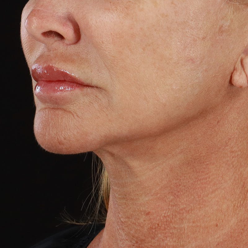 Microneedling Before & After Gallery - Patient 135177 - Image 5
