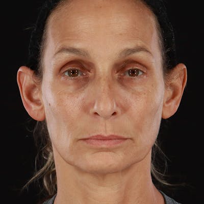 PRP/PRF Therapy Before & After Gallery - Patient 376822 - Image 1