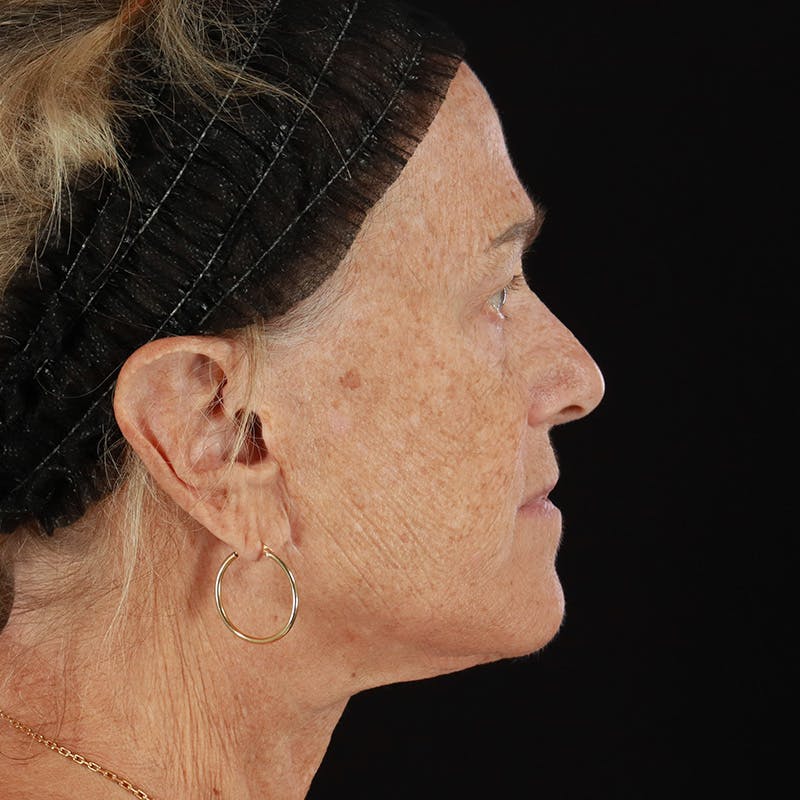 Dermal Fillers Before & After Gallery - Patient 422650 - Image 5