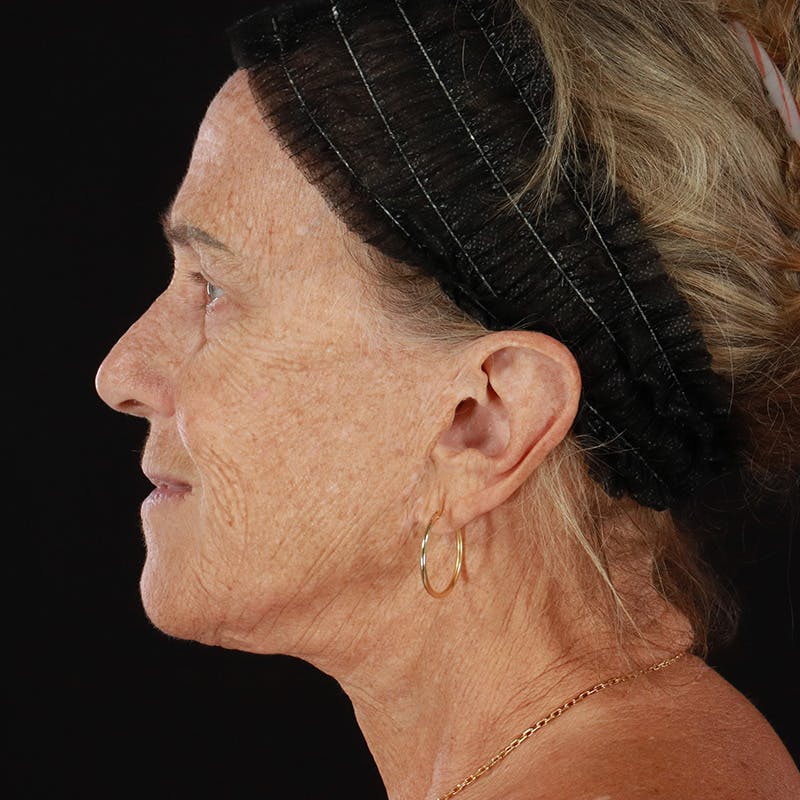 Dermal Fillers Before & After Gallery - Patient 422650 - Image 9