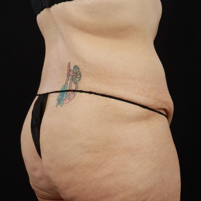 Body Lift Before & After Gallery - Patient 410585 - Image 11