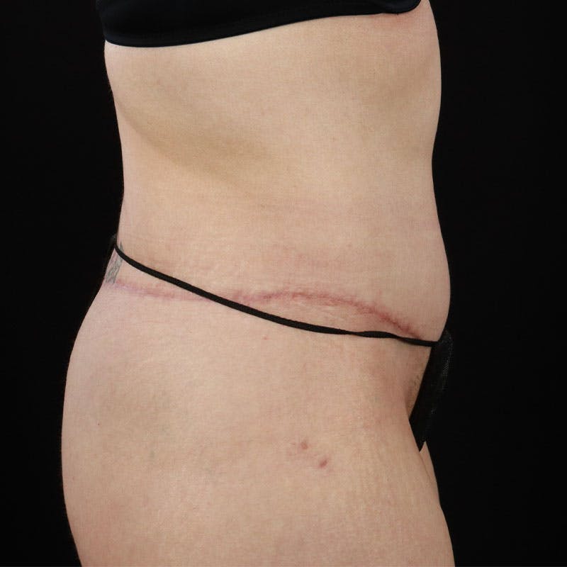 Body Lift Before & After Gallery - Patient 410585 - Image 14