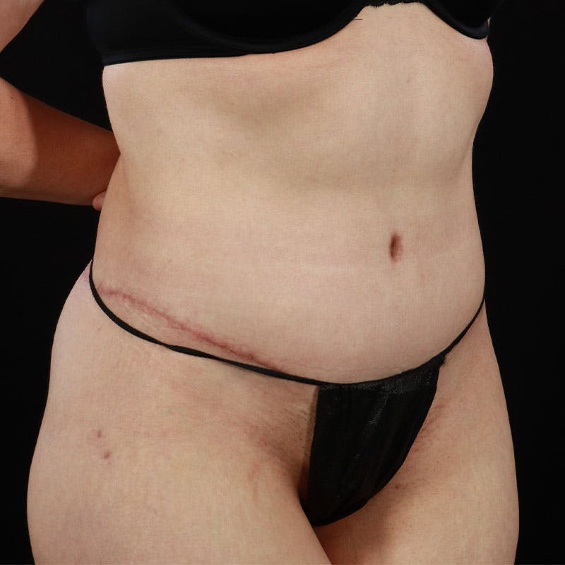 Body Lift Before & After Gallery - Patient 410585 - Image 16